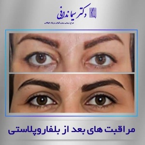 جراحی-پلک-کرج-8
