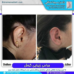 جراحی-گوش-در-کرج-10