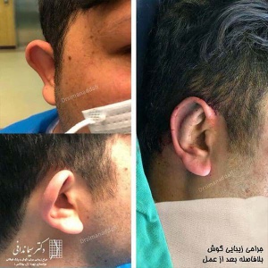 جراحی-گوش-در-کرج-11