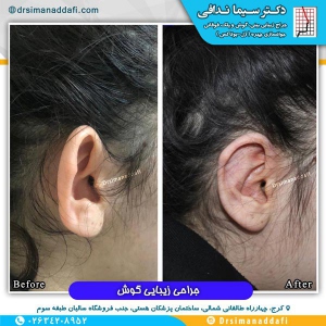 جراحی-گوش-در-کرج-2