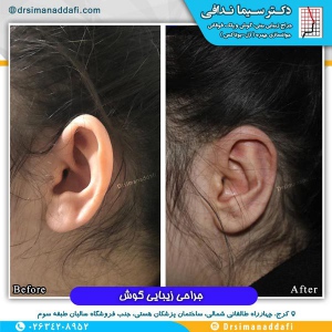 جراحی-گوش-در-کرج-3