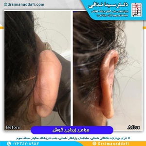 جراحی-گوش-در-کرج-4
