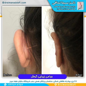 جراحی-گوش-در-کرج-5