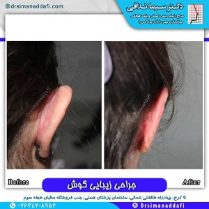 جراحی-گوش-در-کرج-6