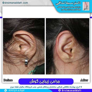جراحی-گوش-در-کرج-7