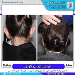 جراحی-گوش-در-کرج-8
