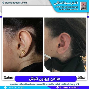 جراحی-گوش-در-کرج-9