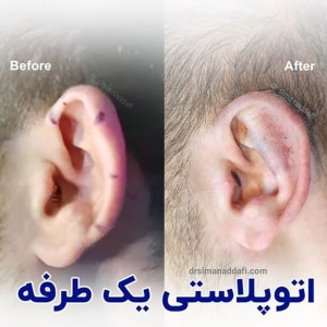 otoplasty-14