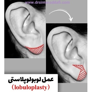 otoplasty-15