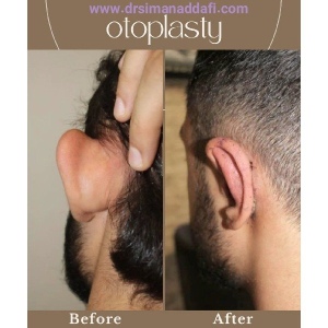 otoplasty-16