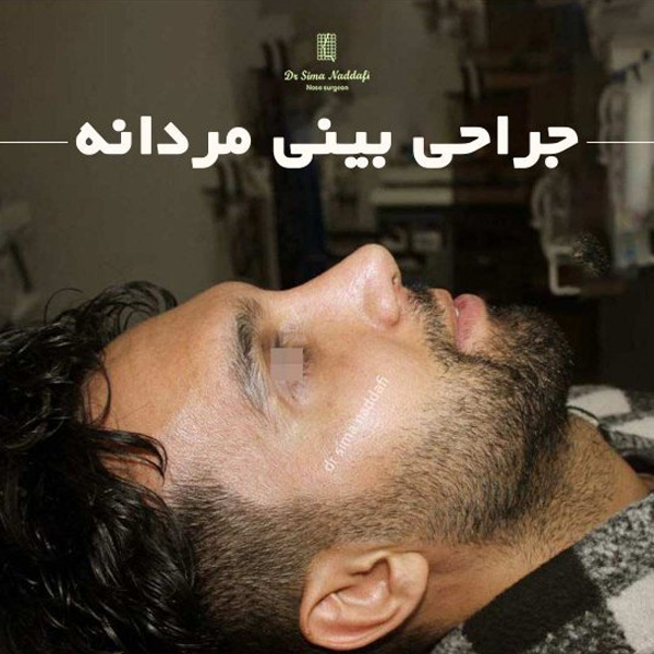 جراحی بینی مردانه + دکتر سیما ندافی