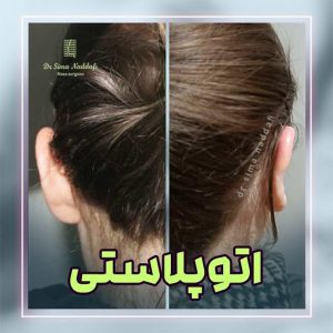 جراحی گوش در کرج - دکتر سیما ندافی