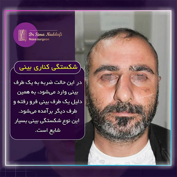 انواع شکستگی بینی