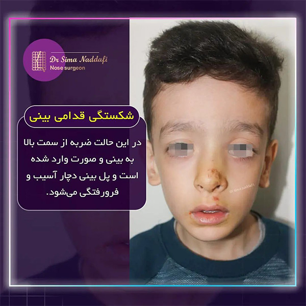 انواع شکستگی بینی