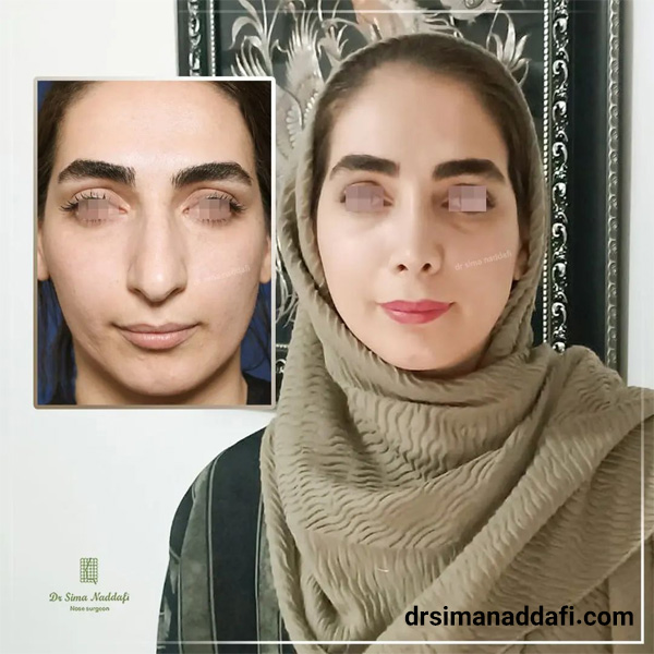 عکس عمل بینی گوشتی و پهن