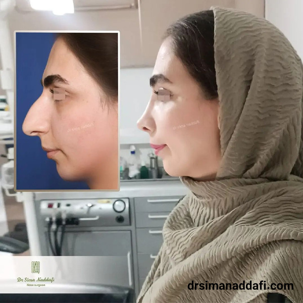 عکس عمل بینی گوشتی و پهن