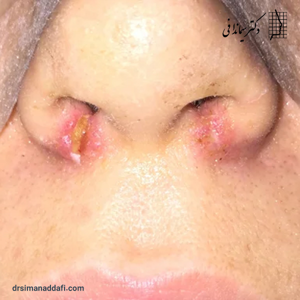 عکس گوشت اضافه بینی بعد از عمل