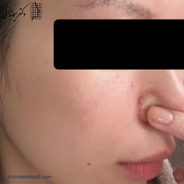 عکس گوشت اضافه بینی بعد از عمل