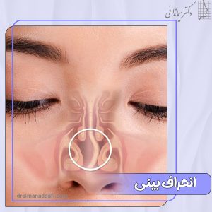 انحراف بینی چیست و چه درمانی دارد