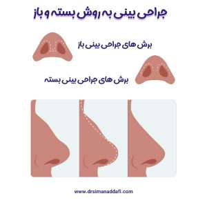 جراحی بینی بسته + دکتر سیما ندافی 