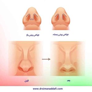 جراحی بینی بسته + دکتر سیما ندافی