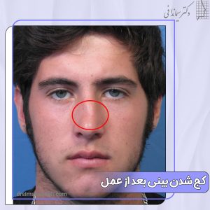 کج شدن بینی بعد از عمل