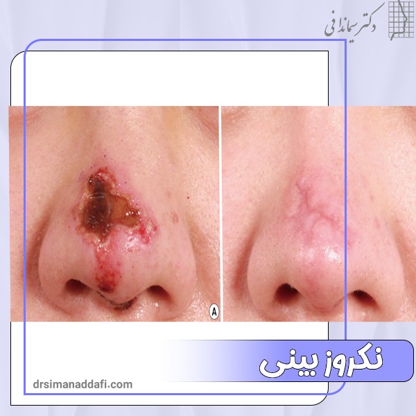 نکروز بینی