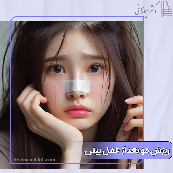 ریزش مو بعد از عمل بینی
