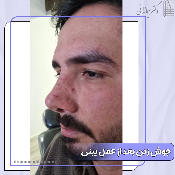 جوش زدن بعد از عمل بینی