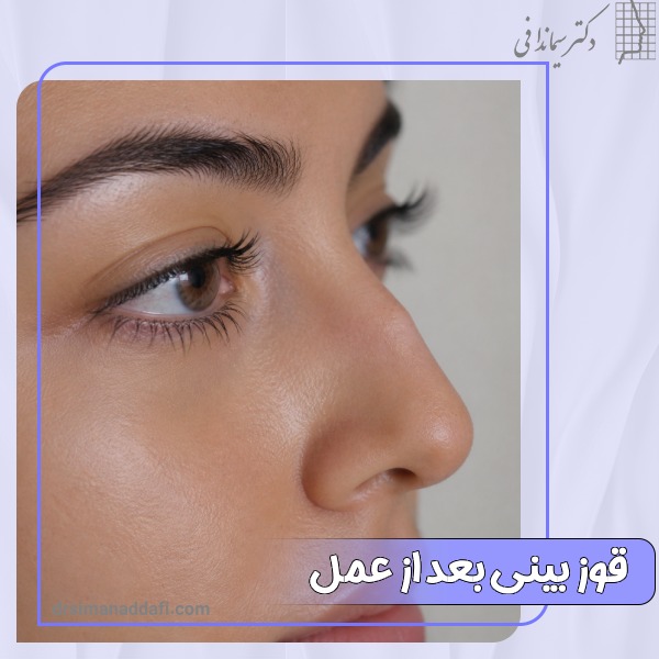 قوز بینی بعد از عمل