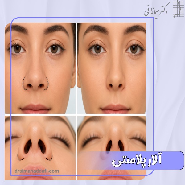آلار پلاستی